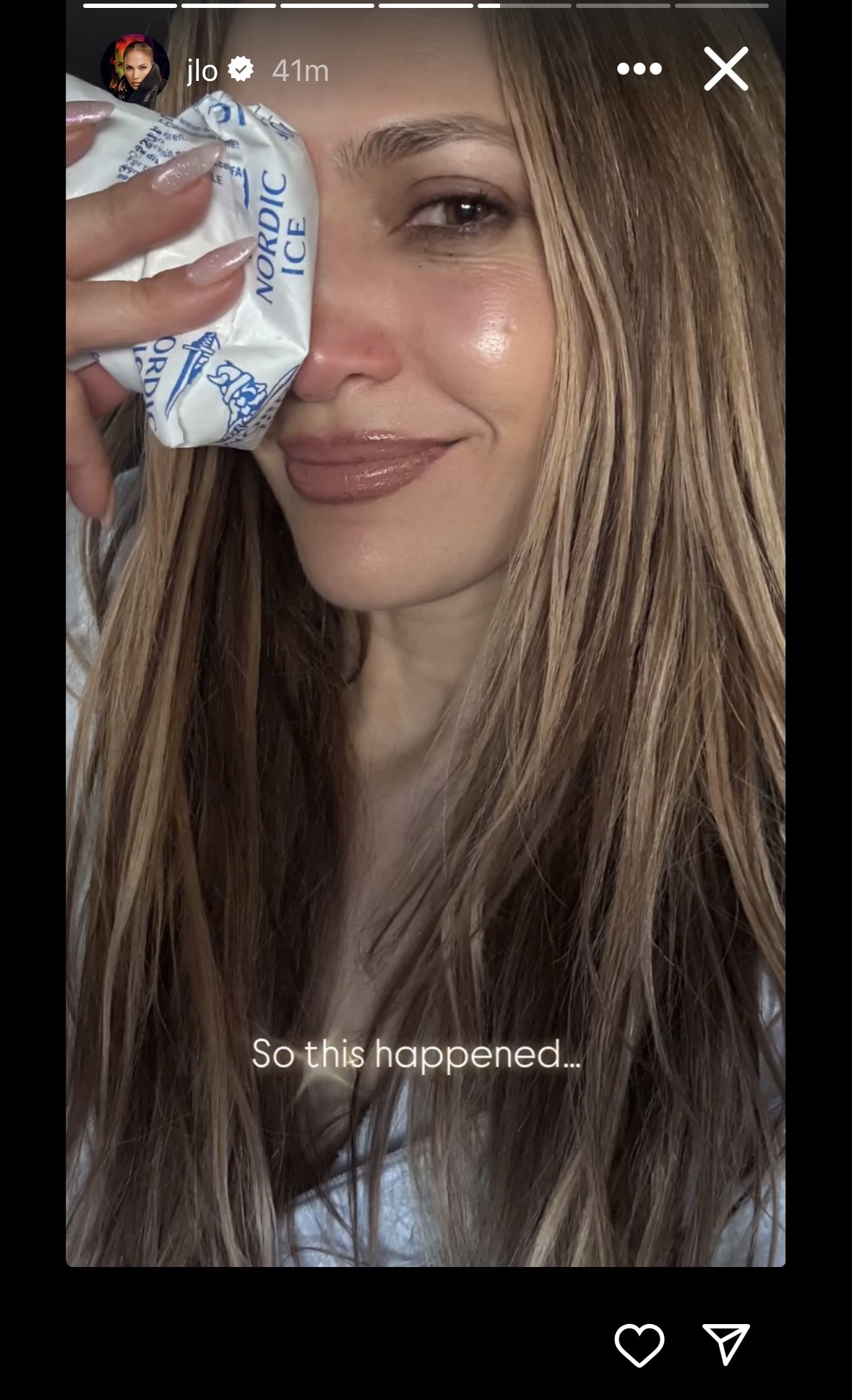 Jennifer Lopez Shares Photos of Severe Facial Injury From AMAs Rehearsals